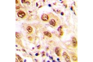 Immunohistochemical analysis of JUND (pS255) staining in human lung cancer formalin fixed paraffin embedded tissue section. (JunD 抗体  (C-Term, pSer255))