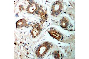 Immunohistochemistry of paraffin-embedded human breast carcinoma using Phospho-YWHAZ-S58 antibody (ABIN2987575). (14-3-3 zeta 抗体  (pSer58))