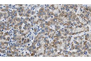 ABIN6274605 at 1/100 staining Human liver cancer tissue by IHC-P. (Cadherin 8 抗体  (Internal Region))