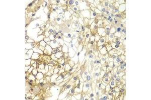 Immunohistochemistry of paraffin-embedded human kidney cancer using SDC1 antibody at dilution of 1:200 (400x lens). (Syndecan 1 抗体)