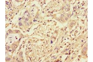 Immunohistochemistry of paraffin-embedded human pancreatic cancer using ABIN7164173 at dilution of 1:100 (CWC22 抗体  (AA 360-623))