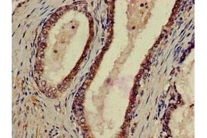 Immunohistochemistry of paraffin-embedded human prostate cancer using ABIN7162439 at dilution of 1:100 (P2RX1 抗体  (AA 54-175))