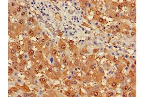 Immunohistochemistry of paraffin-embedded human liver cancer using ABIN7163274 at dilution of 1:100 (Phosphoglucomutase 1 抗体  (AA 1-562))