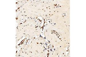 Immunohistochemistry analysis of paraffin embedded human breast cancer using C23 (ABIN7074906) at dilution of 1: 550 (Nucleolin 抗体)