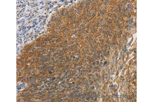 Immunohistochemistry of Human breast cancer using MAPK6 Polyclonal Antibody at dilution of 1:40 (MAPK6 抗体)
