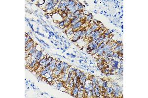 Immunohistochemistry of paraffin-embedded human colon carcinoma using J Rabbit mAb (ABIN7268036) at dilution of 1:100 (40x lens). (JAK1 抗体)