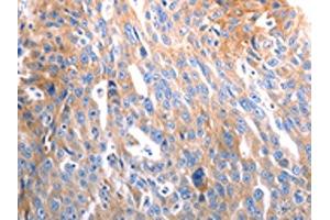 The image on the left is immunohistochemistry of paraffin-embedded Human ovarian cancer tissue using ABIN7192492(SLC44A1 Antibody) at dilution 1/25, on the right is treated with synthetic peptide. (SLC44A1 抗体)