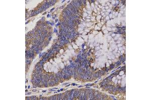 Immunohistochemistry of paraffin-embedded human rectum cancer using EPHX2 antibody at dilution of 1:200 (x40 lens) (EPHX2 抗体)