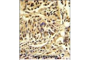 Formalin-fixed and paraffin-embedded human lung carcinoma reacted with CEBPB Antibody (C-term), which was peroxidase-conjugated to the secondary antibody, followed by DAB staining.