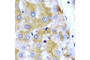 Immunohistochemical analysis of GNT1 staining in human liver cancer formalin fixed paraffin embedded tissue section. (Ugt1 抗体)