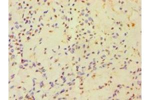 Immunohistochemistry of paraffin-embedded human breast cancer using ABIN7154834 at dilution of 1:100 (HAUS3 抗体  (AA 384-603))