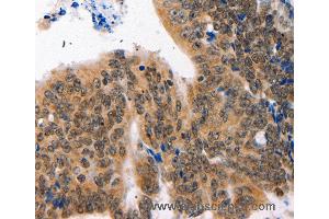 Immunohistochemistry of Human colon cancer using NAIF1 Polyclonal Antibody at dilution of 1:60 (NAIF1 抗体)