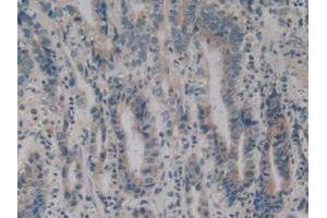 IHC-P analysis of Human Stomach Cancer Tissue, with DAB staining. (BMF 抗体  (AA 1-181))