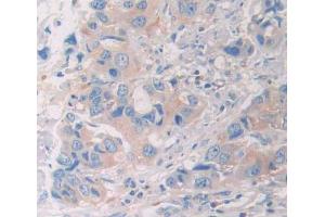 DAB staining on fromalin fixed paraffin- embedded breast cancer tissue) (UBE2S 抗体  (AA 1-209))