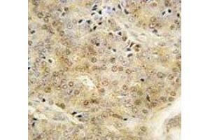 IHC analysis of FFPE human prostate carcinoma tissue stained with EZH1 antibody (EZH1 抗体  (AA 393-422))
