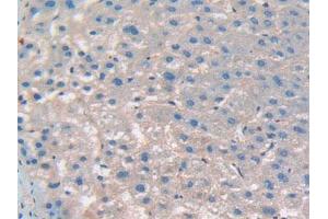 IHC-P analysis of Human Liver Cancer Tissue, with DAB staining. (CD276 抗体  (AA 47-219))