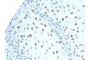 Formalin-fixed, paraffin-embedded human Urothelial Carcinoma stained with p21 Rabbit Recombinant Monoclonal Antibody (CIP1/2275R). (Recombinant p21 抗体)