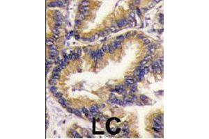 Formalin-fixed and paraffin-embedded human lung carcinoma tissue reacted with URM1 polyclonal antibody  , which was peroxidase-conjugated to the secondary antibody, followed by DAB staining. (Urm1 抗体  (N-Term))