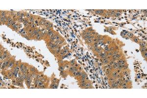 Immunohistochemistry of paraffin-embedded Human gastric cancer tissue using PIK3R3 Polyclonal Antibody at dilution 1:45 (PIK3R3 抗体)