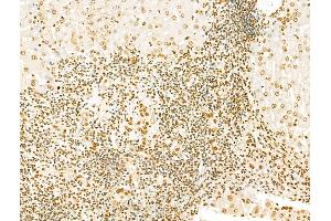 SCXA Antibody at 1/100 staining Human breast cancer by IHC-P. (SCXA 抗体  (Internal Region))