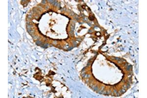 The image on the left is immunohistochemistry of paraffin-embedded Human colon cancer tissue using ABIN7130083(LGALS3BP Antibody) at dilution 1/25, on the right is treated with fusion protein. (LGALS3BP 抗体)