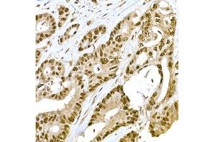 Immunohistochemistry of paraffin-embedded human colon carcinoma using METTL16 Rabbit pAb (ABIN7268501) at dilution of 1:100 (40x lens).