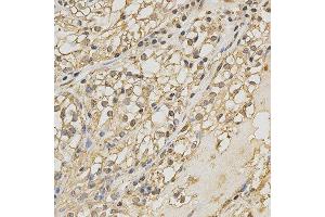 Immunohistochemistry of paraffin-embedded human kidney cancer using PRDX4 antibody at dilution of 1:200 (x400 lens) (Peroxiredoxin 4 抗体)