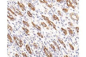 Immunohistochemistry analysis of paraffin-embedded human stomach cancer using CK-7 Monoclonal Antibody at dilution of 1:300. (Cytokeratin 7 抗体)
