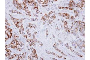 IHC-P Image Immunohistochemical analysis of paraffin-embedded human breast cancer, using IVD, antibody at 1:250 dilution. (IVD 抗体)