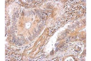 IHC-P Image DAP5 antibody [C2C3], C-term detects EIF4G2 protein at cytosol on human gastric cancer by immunohistochemical analysis.
