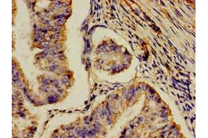 Immunohistochemistry of paraffin-embedded human endometrial cancer using ABIN7159328 at dilution of 1:100 (AOC3 抗体  (AA 27-259))