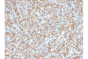 Formalin-fixed, paraffin-embedded human Ewing's Sarcoma stained with Vimentin Mouse Monoclonal Antibody (VM1170). (Vimentin 抗体)