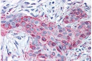 Anti-MMP13 antibody  ABIN1049066 IHC staining of human breast carcinoma. (MMP13 抗体  (Internal Region))