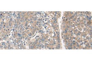 Immunohistochemistry of paraffin-embedded Human liver cancer tissue using CLIC6 Polyclonal Antibody at dilution of 1:40(x200) (CLIC6 抗体)