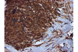 Immunohistochemical staining of paraffin-embedded Adenocarcinoma of Human breast tissue using anti-C1S mouse monoclonal antibody. (C1S 抗体)