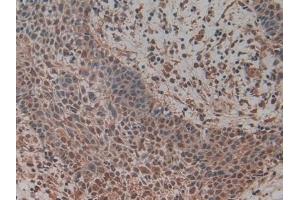 Detection of MCM5 in Human Skin cancer Tissue using Polyclonal Antibody to Minichromosome Maintenance Deficient 5 (MCM5) (Minichromosome Maintenance Deficient 5 (AA 331-537) 抗体)