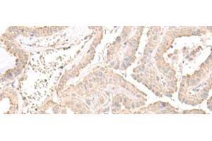 Immunohistochemistry of paraffin-embedded Human thyroid cancer tissue using ERGIC3 Polyclonal Antibody at dilution of 1:50(x200) (ERGIC3 抗体)