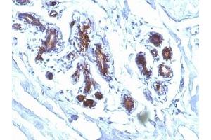 Formalin-fixed, paraffin-embedded human breast carcinoma stained with Lactadherin antibody (EDM45) (MFGE8 抗体)