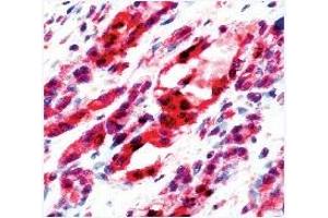 Formalin fixed paraffin embedded human angiosarcoma stained with Flk-1 antibody (VEGFR2/CD309 抗体  (C-Term))