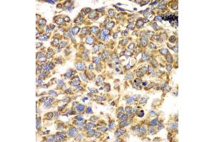 Immunohistochemistry of paraffin-embedded human esophageal cancer using TOMM20 antibody (ABIN5974102) at dilution of 1/100 (40x lens). (TOMM20 抗体)