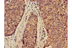 Immunohistochemistry of paraffin-embedded human ovarian cancer using ABIN7170127 at dilution of 1:100 (SLC2A9 抗体  (AA 473-511))
