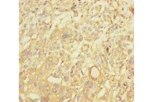 Immunohistochemistry of paraffin-embedded human pancreatic cancer using ABIN7161254 at dilution of 1:100 (NBAS 抗体  (AA 1-70))