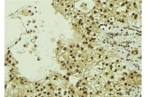 ABIN6267183 at 1/100 staining Human breast cancer tissue by IHC-P.