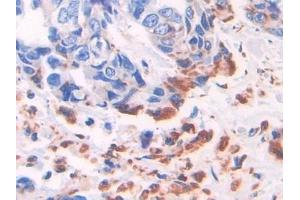 Detection of ADRP in Human Breast cancer Tissue using Polyclonal Antibody to Adipose Differentiation Related Protein (ADRP) (ADRP 抗体  (AA 245-433))