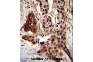 CCD antibody (C-term) (ABIN654810 and ABIN2844484) immunohistochemistry analysis in formalin fixed and paraffin embedded human bladder carcinoma followed by peroxidase conjugation of the secondary antibody and DAB staining. (CCDC122 抗体  (C-Term))