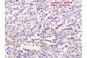 Formalin-fixed and paraffin embedded human liver cancer labeled with Anti ADCY10 Polyclonal Antibody, Unconjugated (ABIN751093) followed by conjugation to the secondary antibody and DAB staining (ADCY10 抗体  (AA 1101-1200))