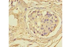 Immunohistochemistry of paraffin-embedded human breast cancer using ABIN7153665 at dilution of 1:100 (Non-Syndromic Hearing Impairment Protein 5 (GSDME) (AA 1-496) 抗体)