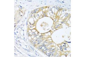 Immunohistochemistry of paraffin-embedded human colon carcinoma using GNAI3 antibody. (GNAI3 抗体)