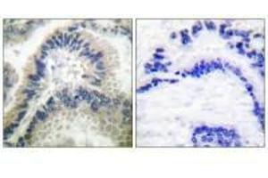 Immunohistochemical analysis of paraffin-embedded human lung carcinoma tissue using Guanylate Cyclase β antibody. (GUCY1B3 抗体)