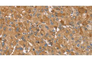 Immunohistochemistry of paraffin-embedded Human liver cancer using TRIM34 Polyclonal Antibody at dilution of 1:30 (TRIM34 抗体)